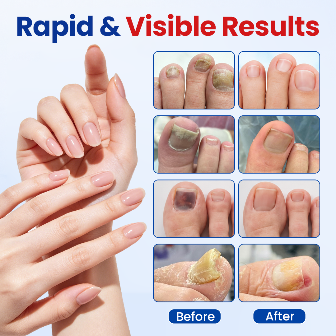 ROSOPLTMFungal Nail Repair Patches