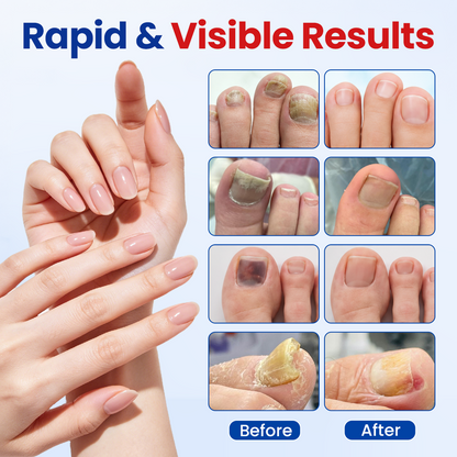 ROSOPLTMFungal Nail Repair Patches