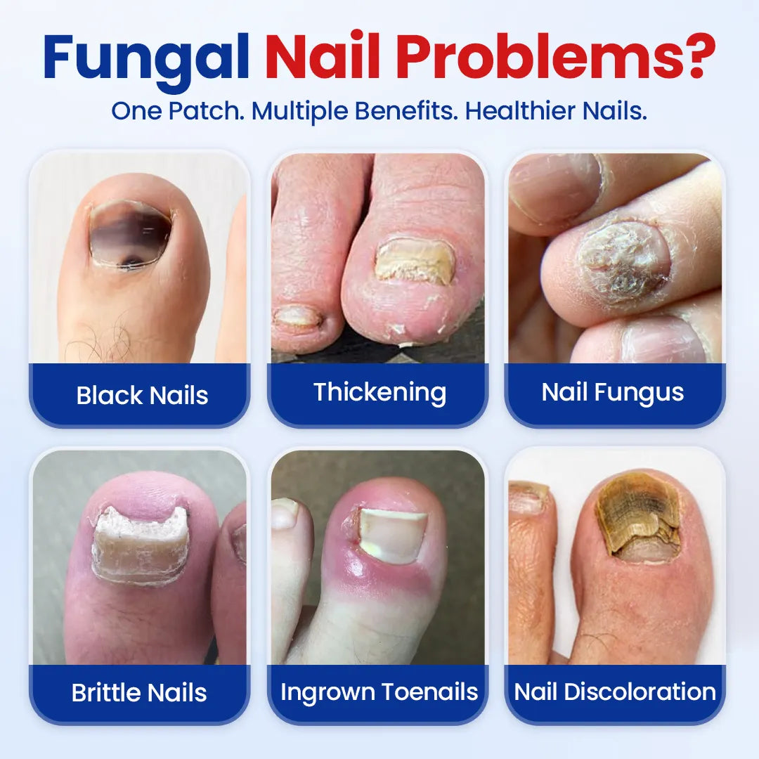 ROSOPLTMFungal Nail Repair Patches
